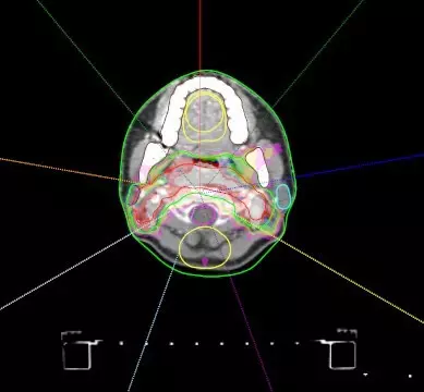 비인두암의 일반적인 치료 방법