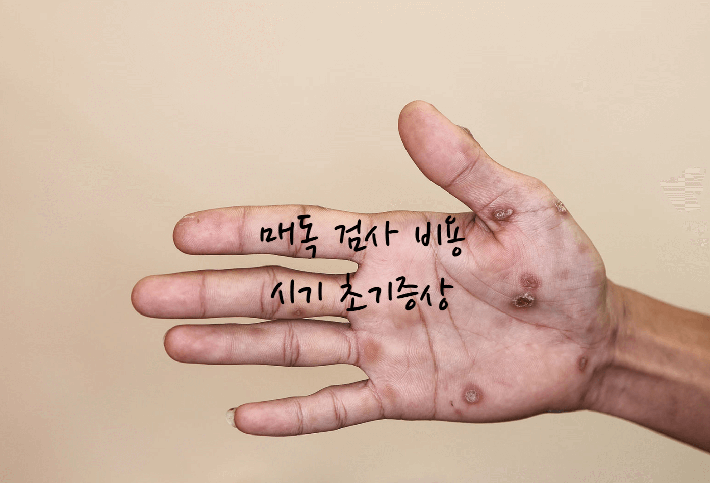 매독 검사
