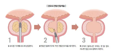 전립선비대증 치료