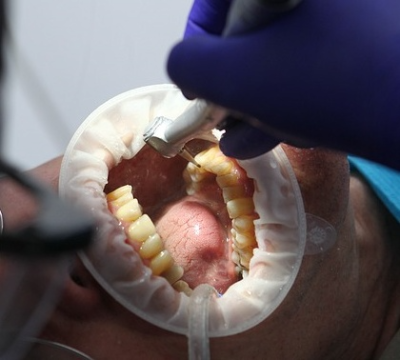 사랑니-발치-과정