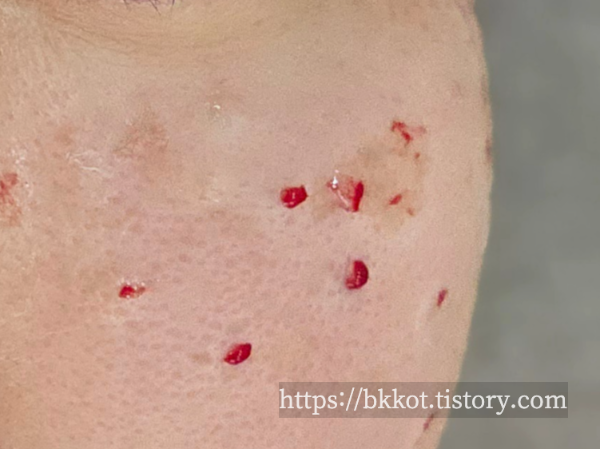 흑자제거 리팟레이저 후기