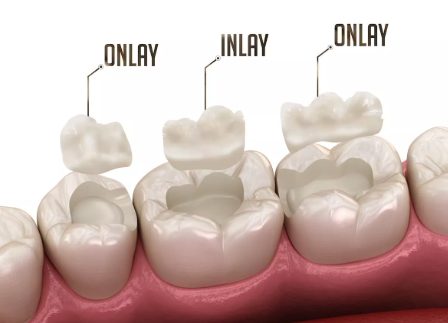 충치 레진 vs 인레이 실비 비용
