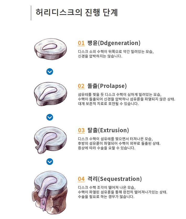 허리-디스크 -진행단계