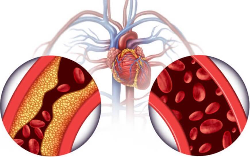 심장마비 전조증상