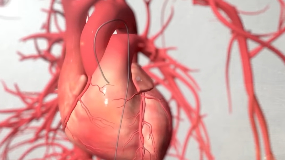 관상동맥 조영술