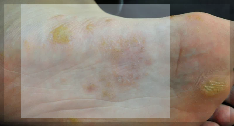 발바닥과 주변 수포형 무좀