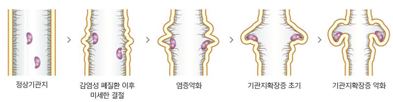 기관지확장증이란