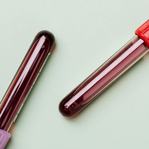 당화혈색소 검사방법 - 당뇨 의심 시 3개월 간격으로 재검