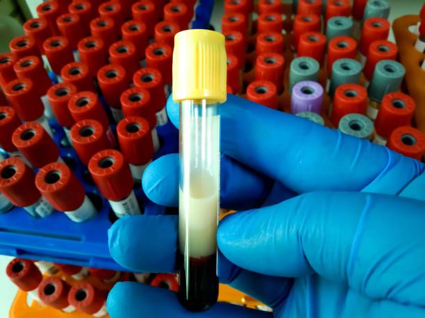 triglycerides 정상 수치