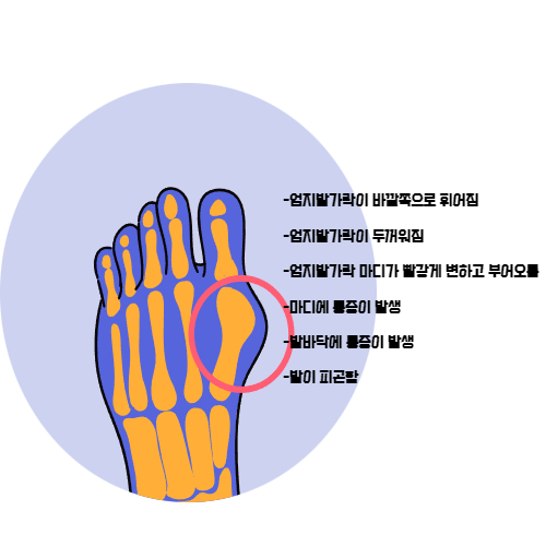 무지외반증-증상-원인-치료방법