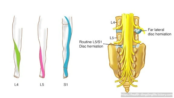 디스크 위치에 따른 방사통 양상/