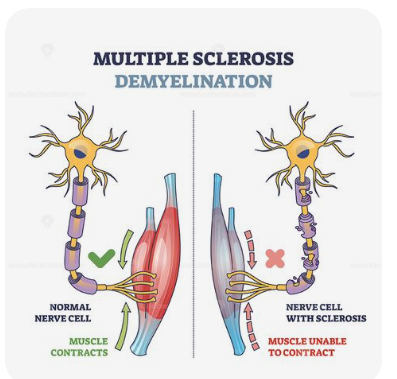 다발성경화증-원인