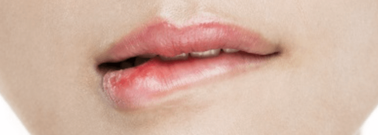 입술수포&amp;#44; 구순포진&amp;#44;헤르페스의 모든 것! 원인과 치료법&amp;#44;