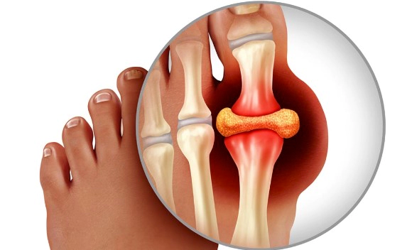 통풍 초기증상 3가지 및 통풍에 안좋은 음식과 좋은 음식 총정리