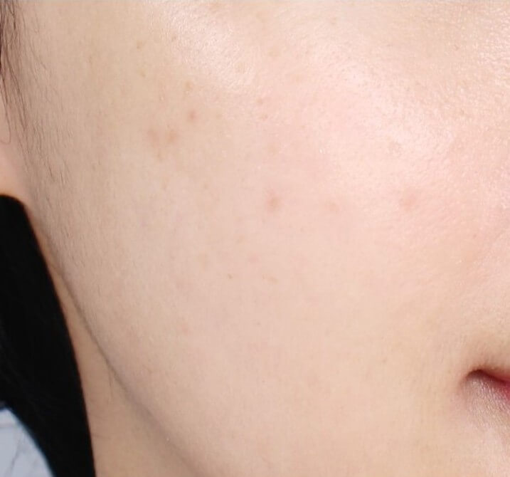 화농성 여드름 치료 후 모습