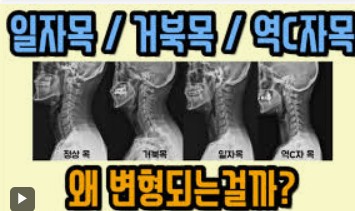 거북목 일자목