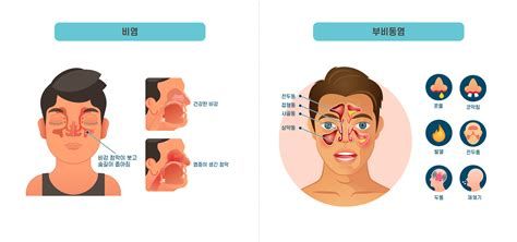 부비동염