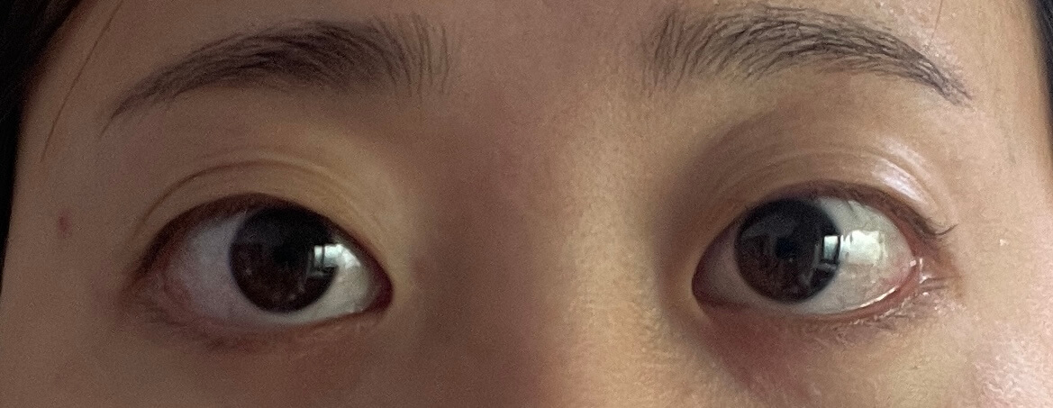 갑상선안병증 증상, 안구돌출