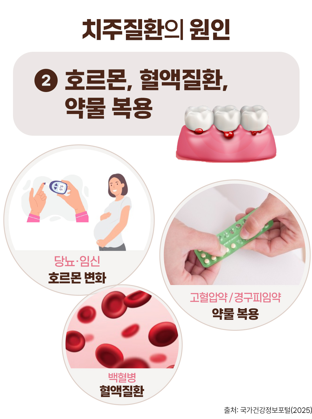 #치주질환의 원인 #호르몬 #혈액질환 #약물 복용