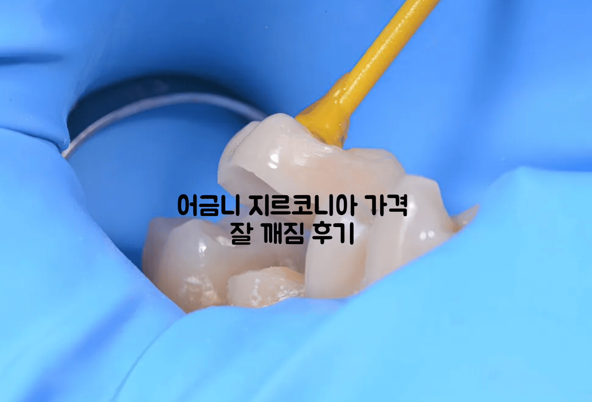 어금니 지르코니아 가격