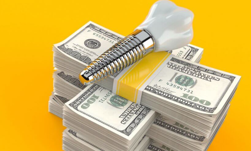 임플란트 가격 어느정도 들까?