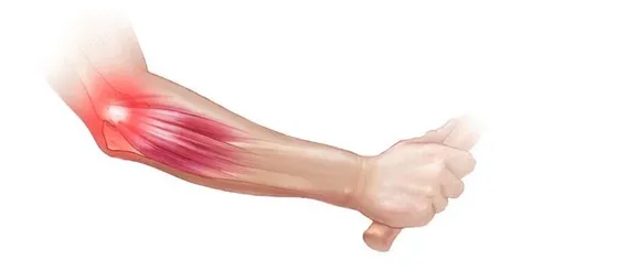 팔꿈치 통증 원인 6가지증상운동법예방법치료법까지_1