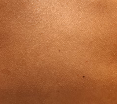 두드러기 치료방법 진단 기준 합병증