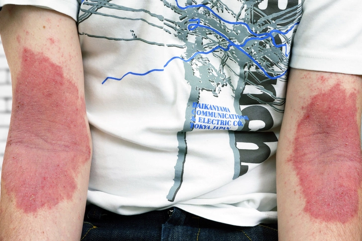 아토피는 타고나는 게 아니라&amp;#44; 관리로 악화됩니다!