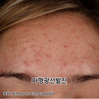 햇빛-알레르기-증상