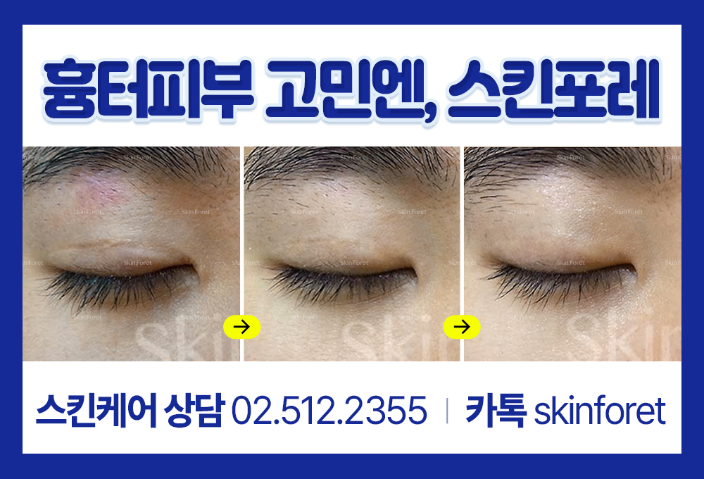 남자 눈성형과 앞트임 흉터 관리 전후 이미지