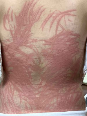 두드러기와 알러지 (알레르기) 반응의 관계 — 표고버섯과의 연관성