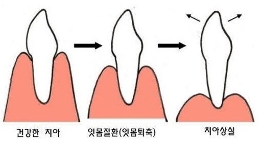잇몸질환 자가진단 체크리스트 관련 사진