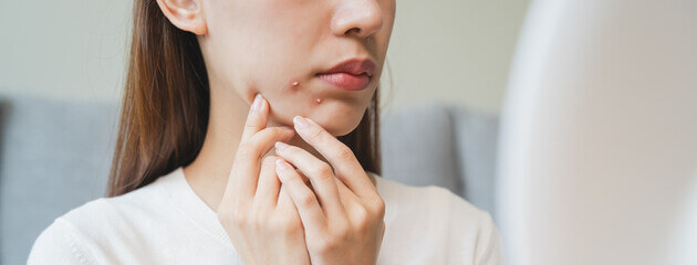 입 주위 뾰루지