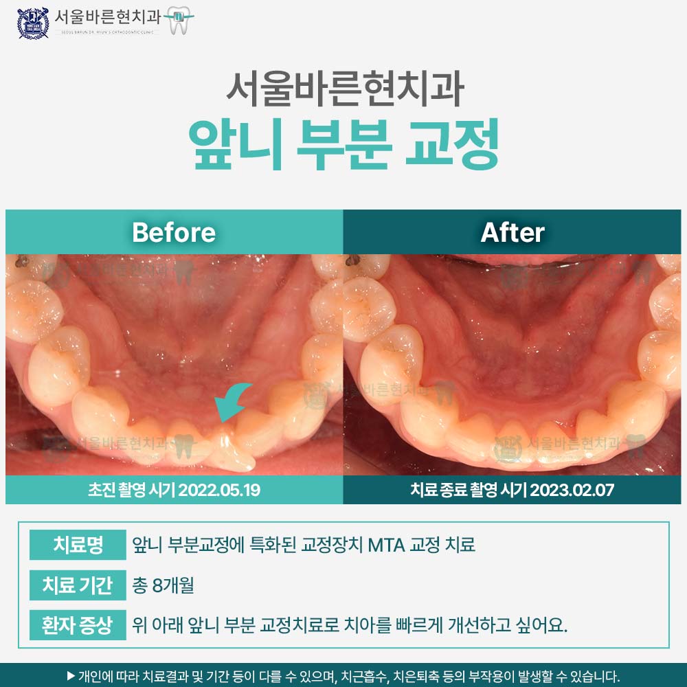 부산치아교정
