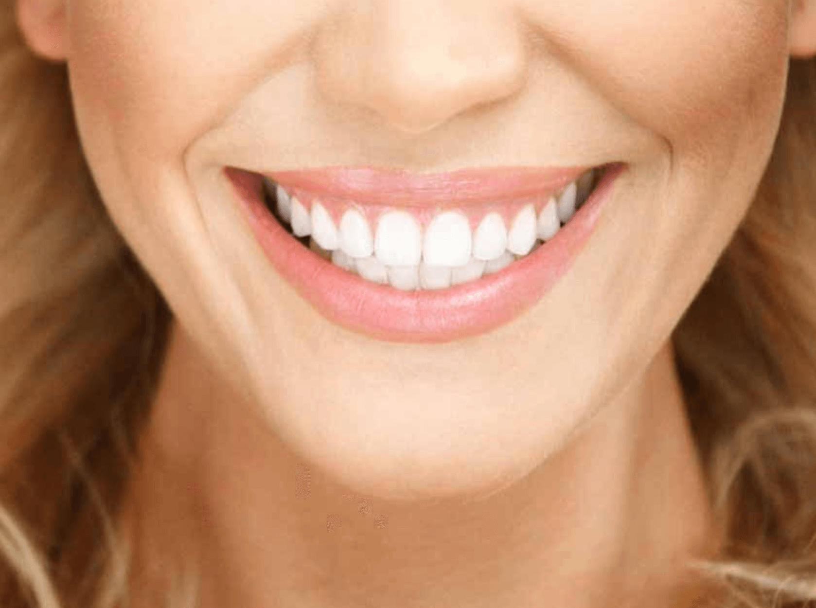 앞니 레진 비용