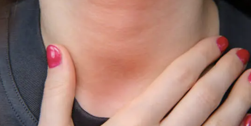 임파선염 증상 7