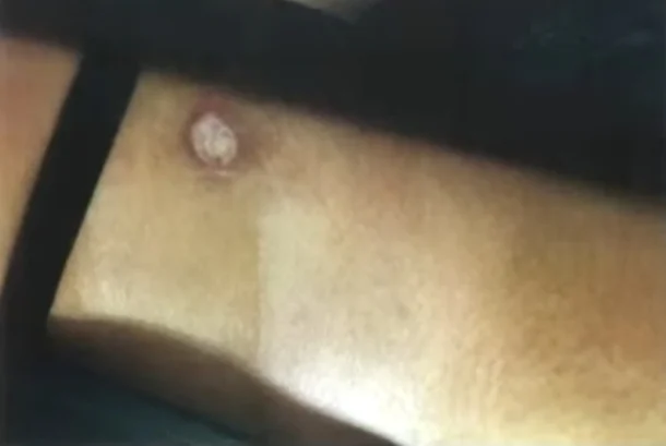 숨진 A양의 어깨에 남겨진 담배빵 자국. [JTBC &lsquo;사건반장&rsquo;]