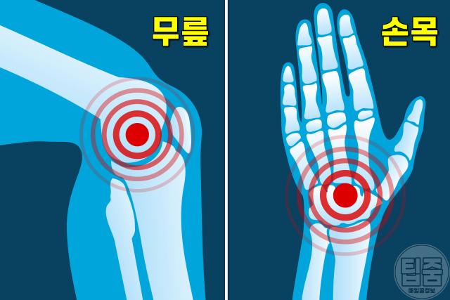 우울증 증상 관절염,팁줌