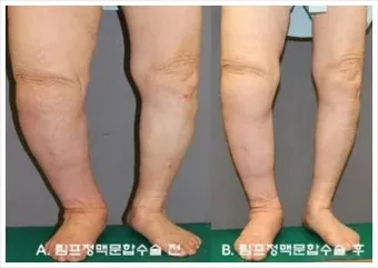 부종의 원인과 증상 5가지 개선방법 치료법_22