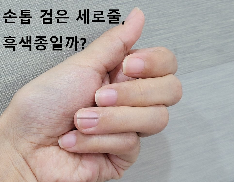 손톱 검은 세로줄 흑색종