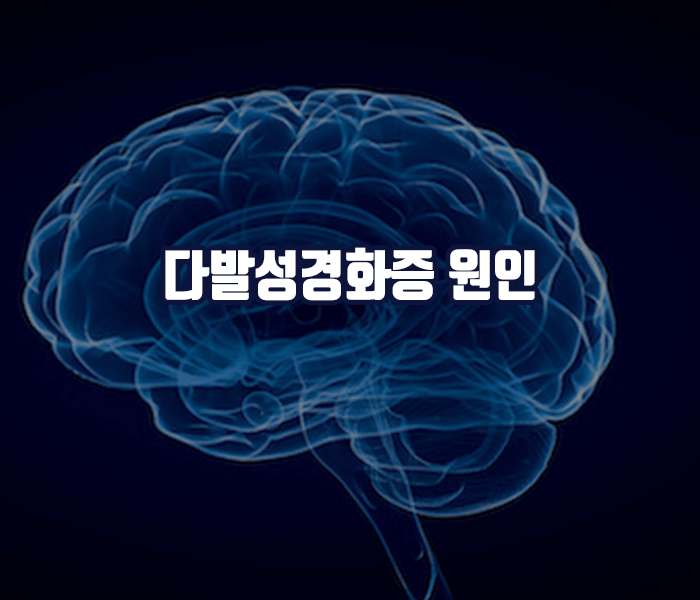 다발성경화증 원인 - 유전적요인, 환경적요인, 면역학적 요인