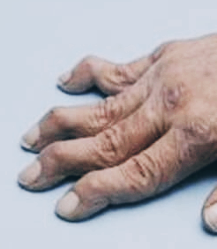 류마티스 관절염 초기증상