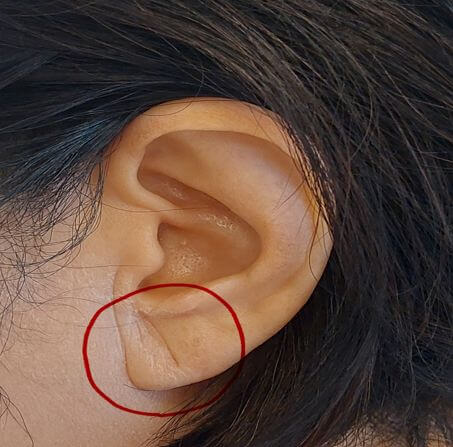 프랭크 징후 단순한 주름이 아님