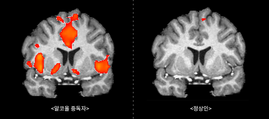 알콜중독 자가진단