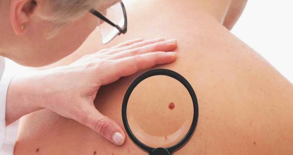 효과적인 쥐젖제거