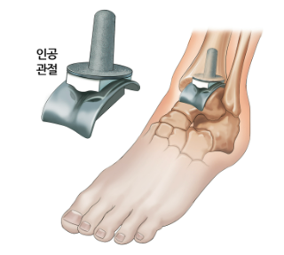 발목 인공관절