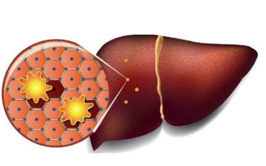 알부민-부족-증상