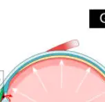 안압이 높아지는 이유 &mdash; 눈 속의 보이지 않는 압력