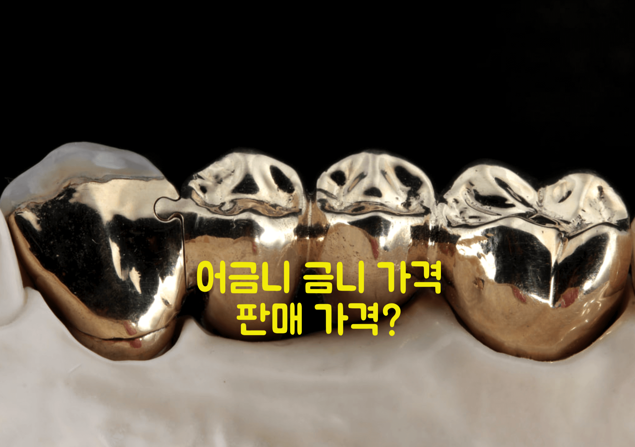 어금니 금니 가격