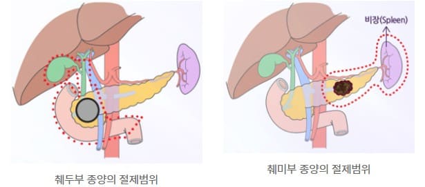 췌장암 초기증상&amp;#44; 췌장암&amp;#44; 췌장암 검사방법&amp;#44; 췌장암 증상&amp;#44; 췌장암 말기4기마지막증상&amp;#44; 췌장암 4기 생존율&amp;#44; 췌장암 등통증 부위&amp;#44; 췌장암에 좋은 음식&amp;#44; 췌장암 3기 생존율&amp;#44; 췌장암 2기 생존율&amp;#44; 췌장암 증상 등통증&amp;#44; 췌장암 생존율